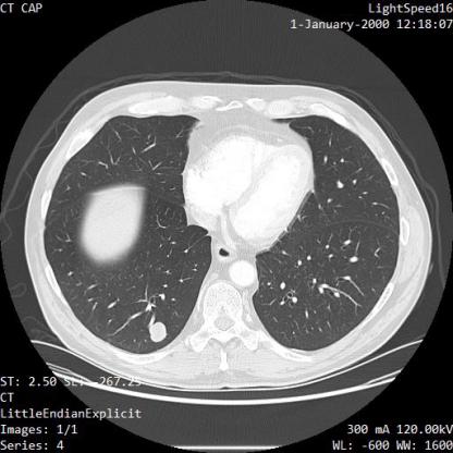 LungNodule_UNET Object Detection Dataset by jaundice