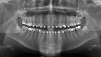 dental seg project thumbnail
