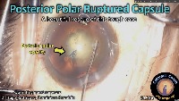 K_CC_1584_posterior cataract  project thumbnail