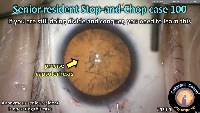 K_CC_1901_case 100 stop and chop project thumbnail