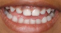 Teeth project thumbnail