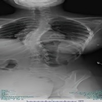 Vertebrae Detection project thumbnail