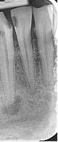 Final anterior teeth project thumbnail
