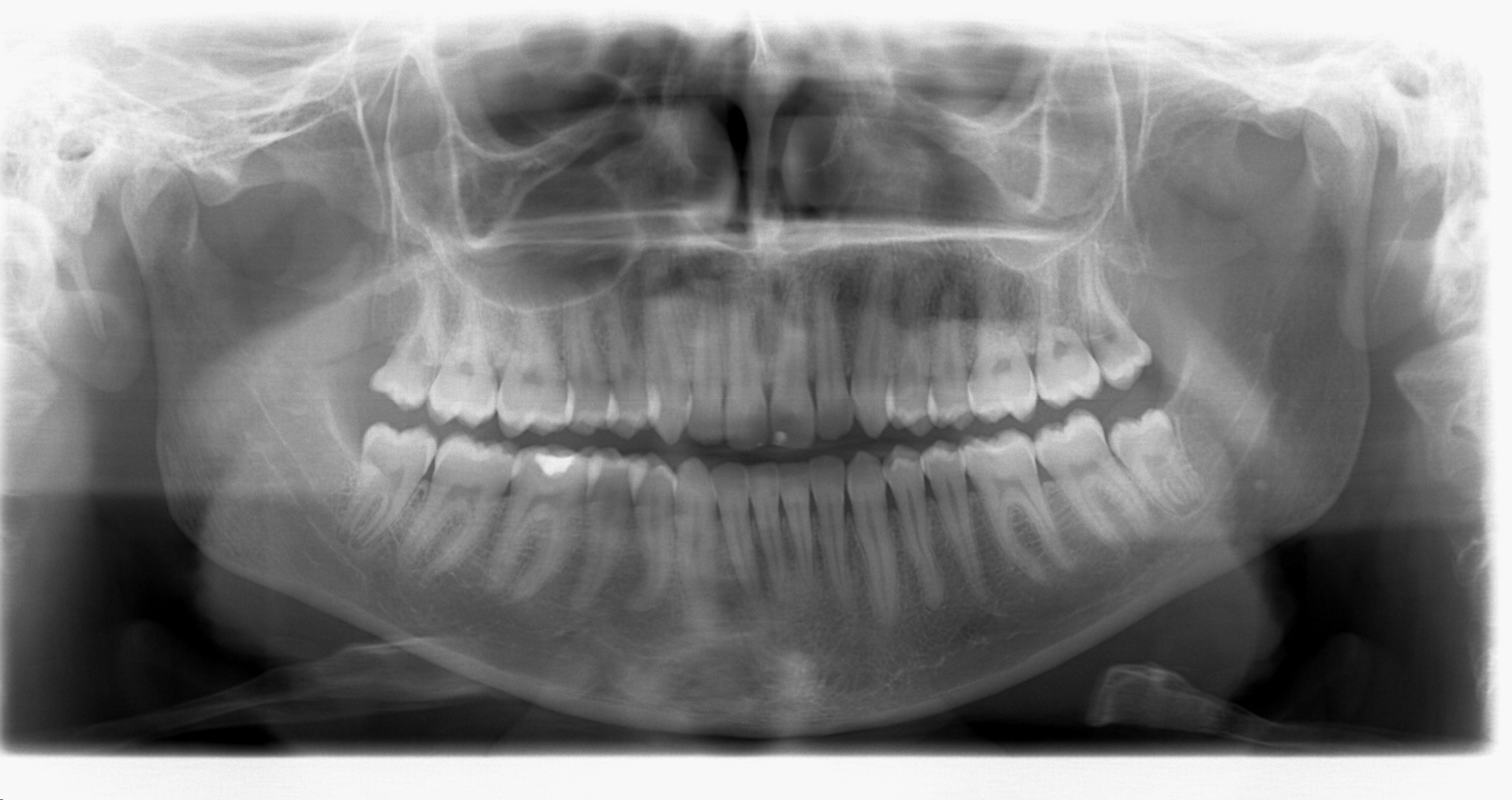Dent Object Dente Object Detection Model by Detection