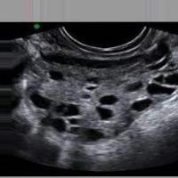PCOS project thumbnail