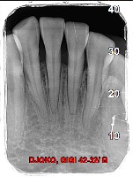 Deteksi Bone Loss project thumbnail