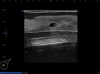 SA, nipple duct lesions project thumbnail