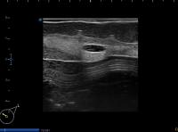 long axis, large UIQ lesion project thumbnail