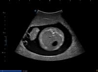 Transverse abdominal view project thumbnail