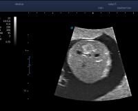 transverse view at renal level project thumbnail