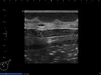 short axis, small UIQ lesion project thumbnail