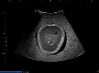 Transventricular transverse view project thumbnail