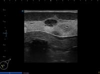 short axis, LIQ lesion project thumbnail