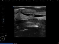 LA, nipple & duct lesions project thumbnail