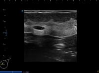 short axis, large UIQ lesion project thumbnail