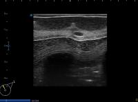 long axis, small UIQ lesion project thumbnail