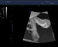 Humerus long axis view project thumbnail
