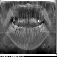 teeth segmentation  project thumbnail