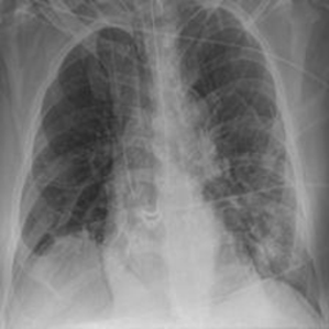 COVID-19 Radiography Database Object Detection Model (v1, 2024-12-08 4 ...