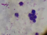 Malaria 2nd dataset project thumbnail