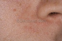 Facial Skin Diseases project thumbnail