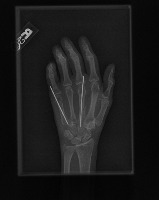 Fractured Bone Detection project thumbnail