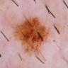 skin cancer detection project thumbnail