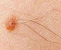 Detecting possible skin cancer project thumbnail