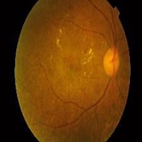 Diabetic Retinopathy project thumbnail