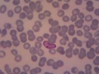 yolo malaria project thumbnail