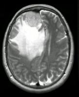 Brain Tumor project thumbnail