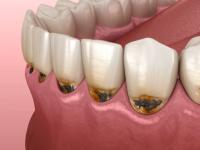 Data_Caries project thumbnail