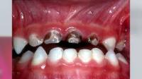 Find caries dentales project thumbnail