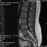 Lumbar Spine project thumbnail