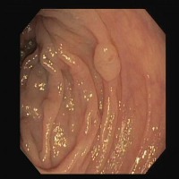 Colonoscopy Object Detection Model by verdant