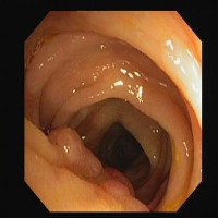 Colonoscopy project thumbnail