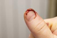 Nailbed Detection project thumbnail