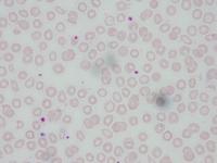 beta-thalassemia-detection-data- project thumbnail