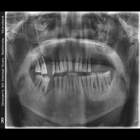 kaggle periapical_truth project thumbnail