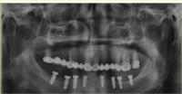 kaggle_prosthetic project thumbnail