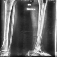 Bone Fracture project thumbnail