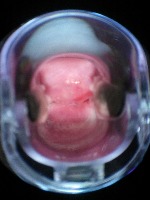 CervicalCancerPrediction project thumbnail