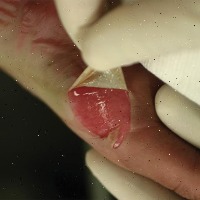 skin_burn project thumbnail