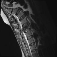 fracture detect project thumbnail