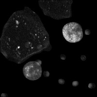 Bladder Cancer Lipid Droplet project thumbnail