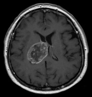 brain mri image Object Detection Model by RP Brain MRI object detection