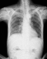 lungs project thumbnail