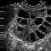 Dataset-cyst-sop-parte-3 project thumbnail