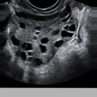 Dataset-cyst-sop-parte-1 project thumbnail