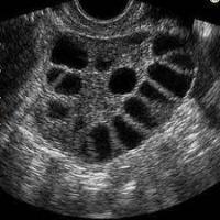 Dataset-cyst-sop-parte-4 project thumbnail